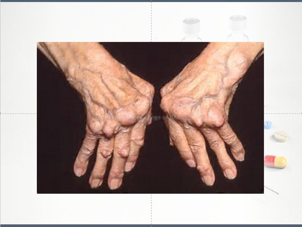 类风湿性关节炎健康教育PPT课件下载3