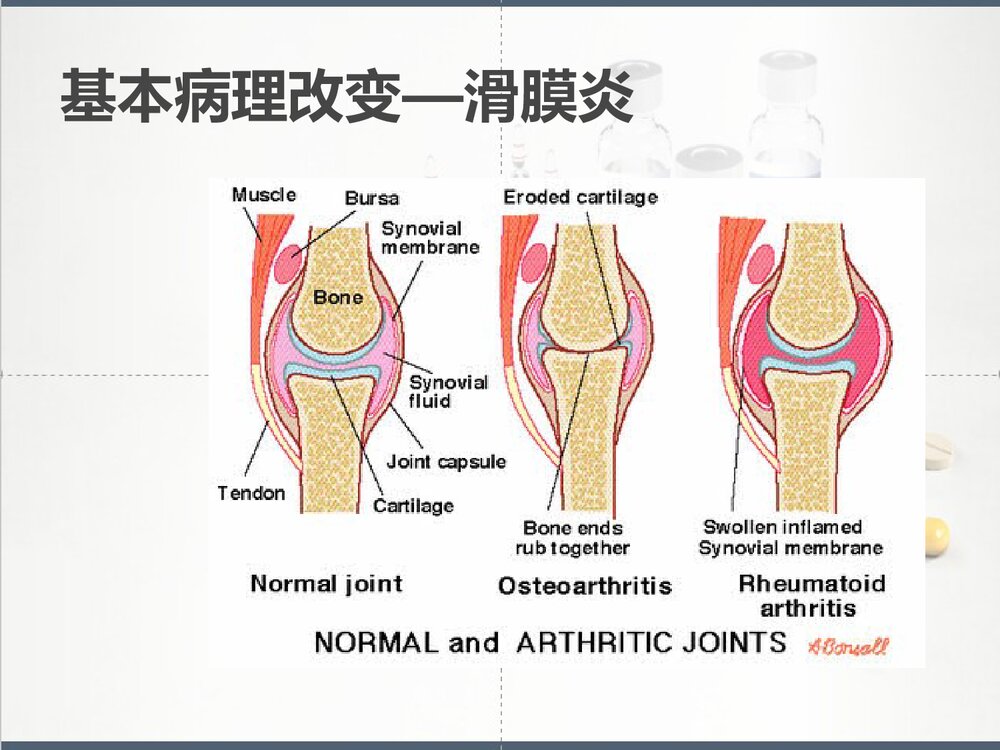 类风湿性关节炎健康教育PPT课件下载7