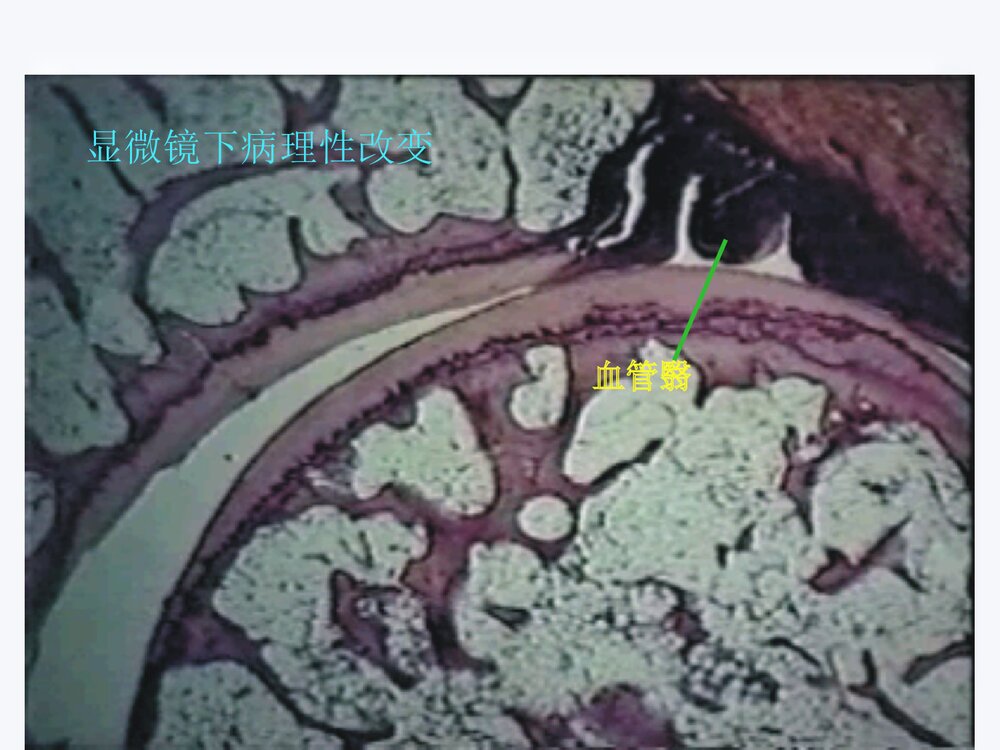 类风湿关节炎的护理查房PPT课件下载5