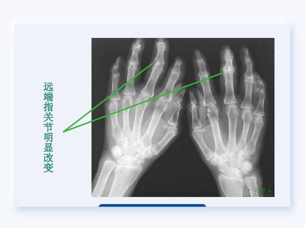 类风湿关节炎的护理查房PPT课件下载10