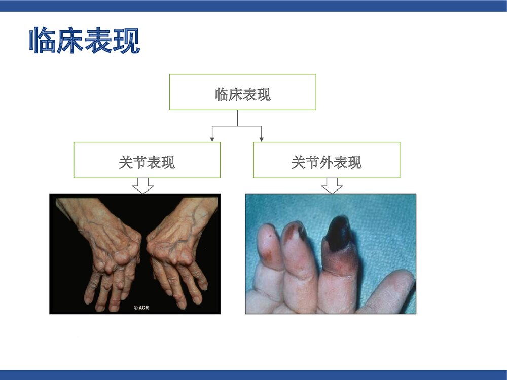 类风湿关节炎(含各种评分标准)PPT课件下载6