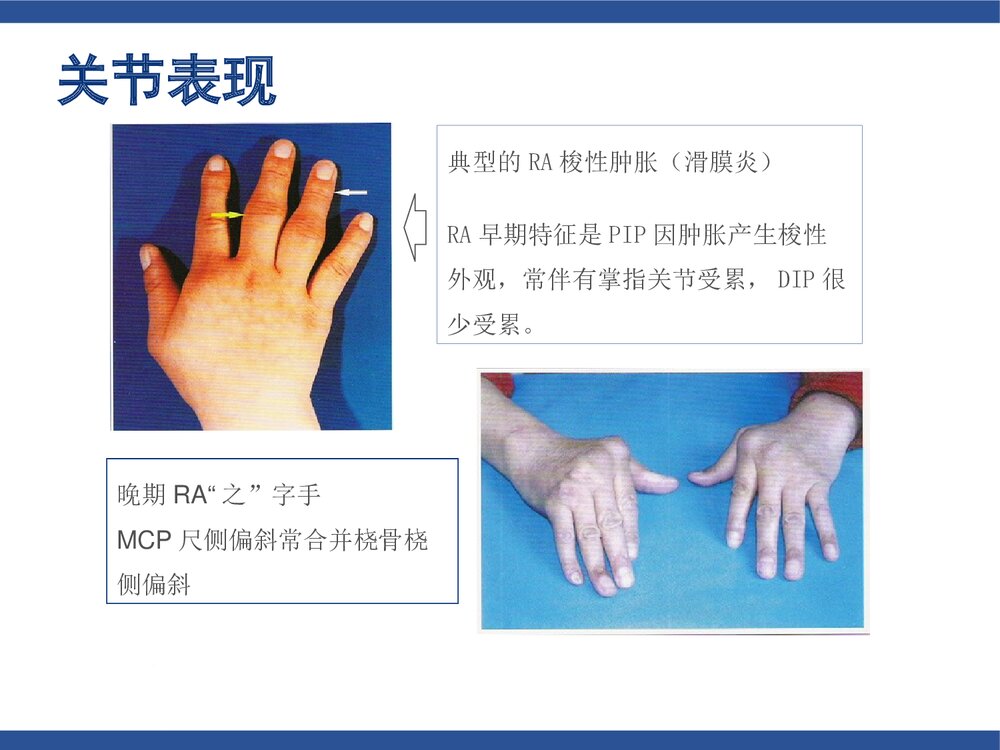 类风湿关节炎(含各种评分标准)PPT课件下载10