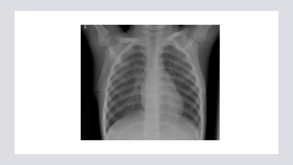 新生儿肺炎PPT课件10