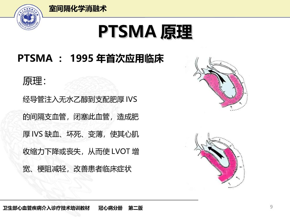 室间隔化学消融术护理PPT课件下载(共33页)9