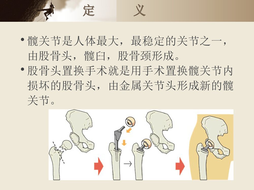 骨头置换术前准备PPT课件2