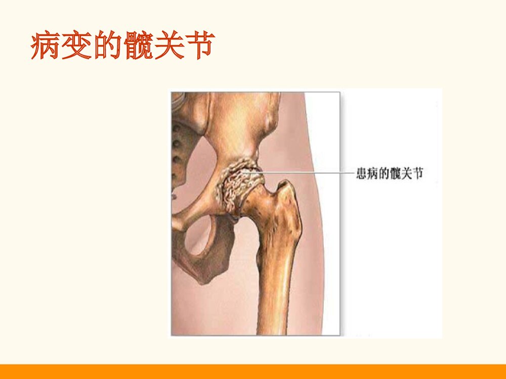 髋关节置换术护理查房PPT课件5