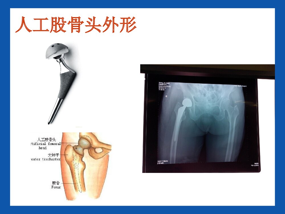 股骨头置换术后康复PPT课件5