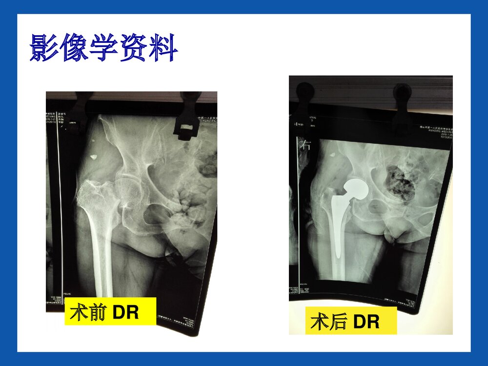股骨头置换术后康复PPT课件9
