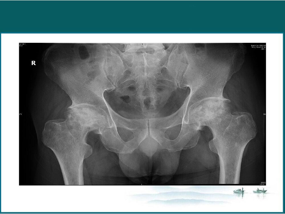 股骨肌坏死PPT课件4