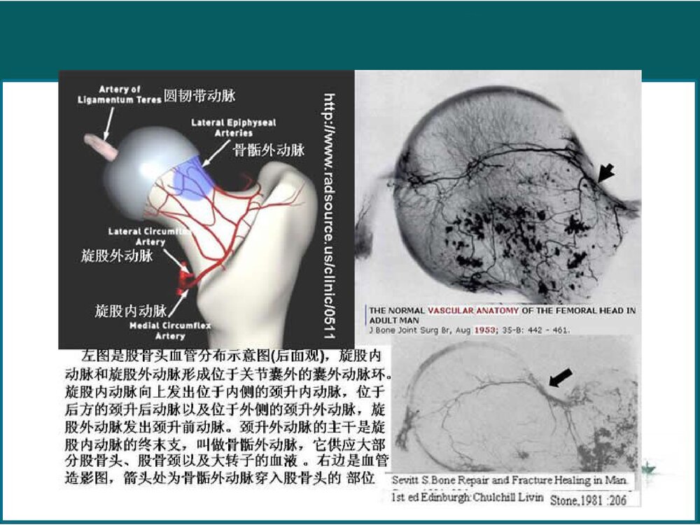 股骨肌坏死PPT课件10