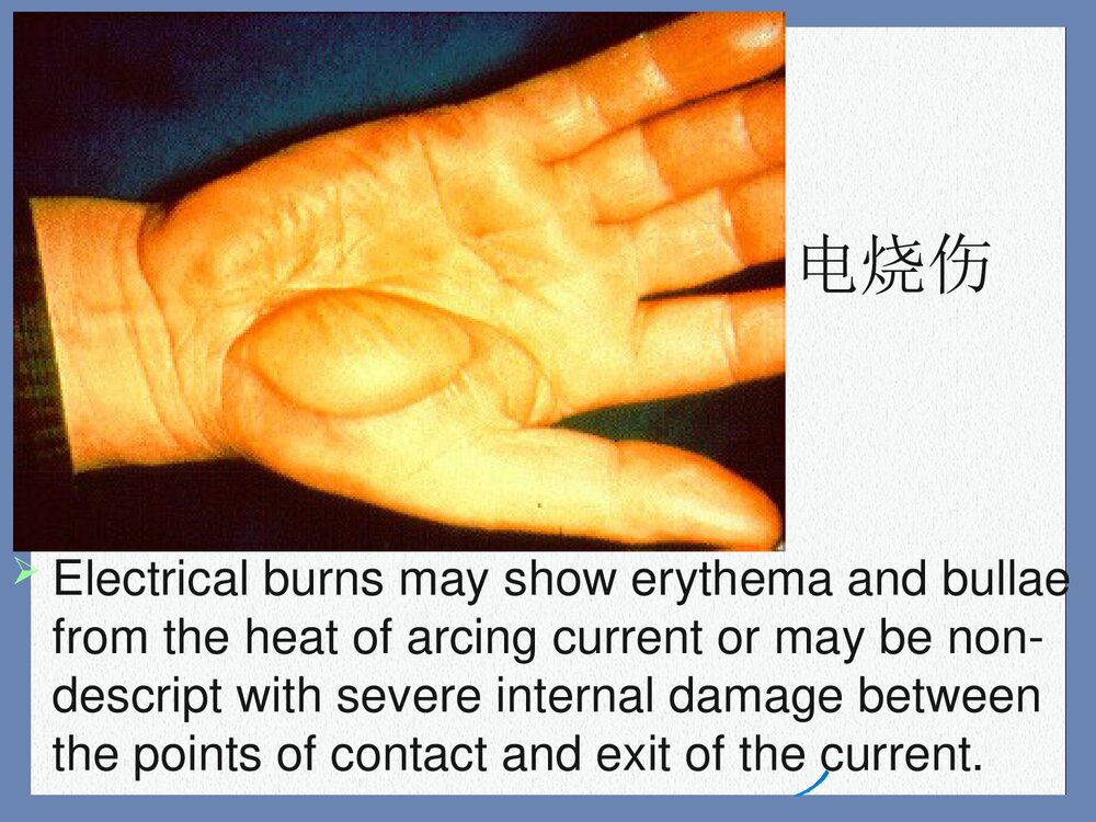 电烧伤与化学烧伤PPT课件下载(共15页)4