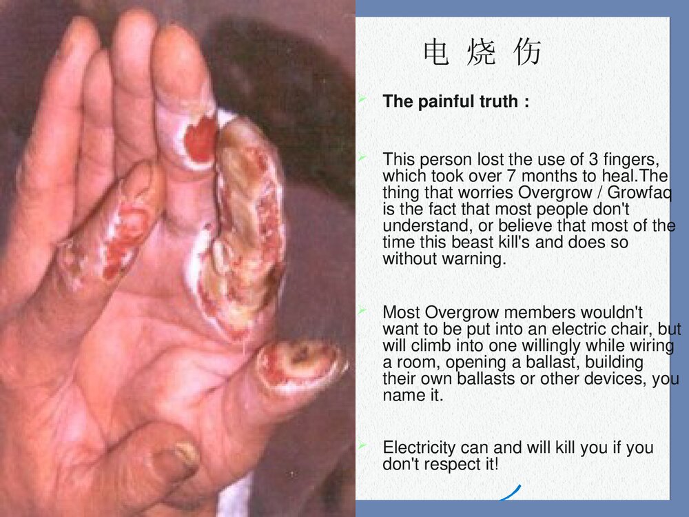 电烧伤与化学烧伤PPT课件下载(共15页)5