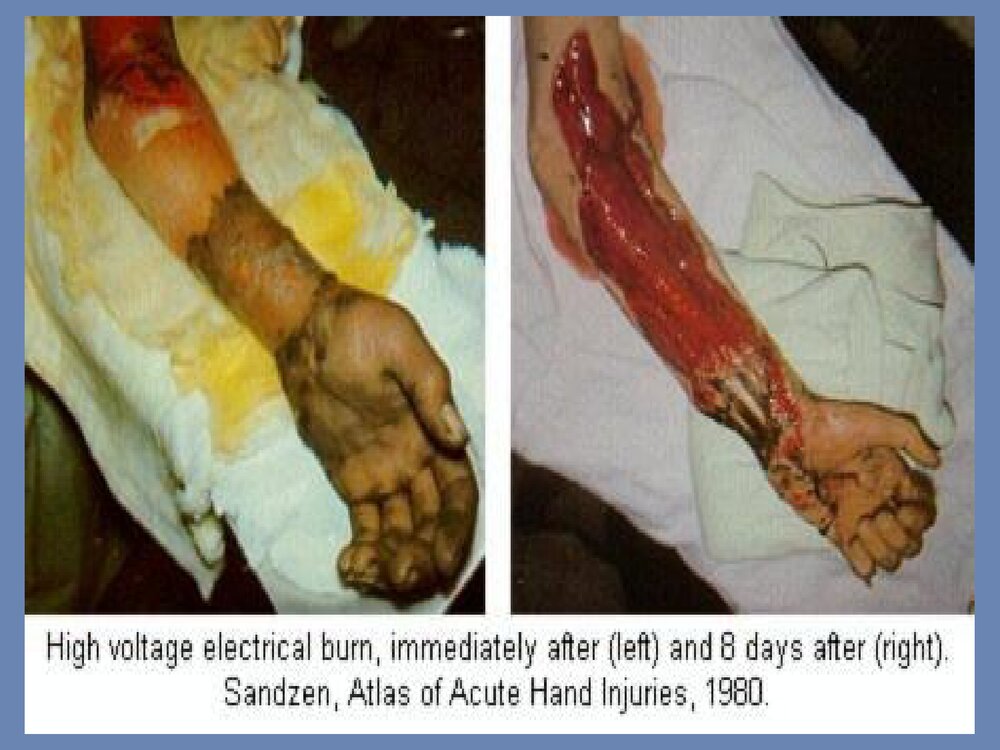 电烧伤与化学烧伤PPT课件下载(共15页)6