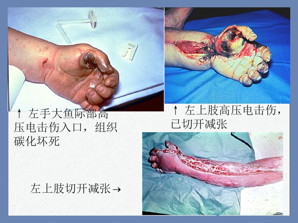 电烧伤与化学烧伤PPT课件下载(共15页)7