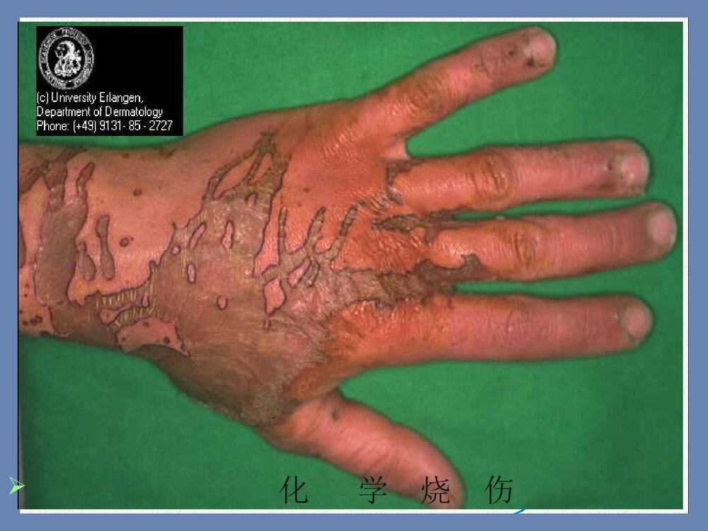 电烧伤与化学烧伤PPT课件下载(共15页)10