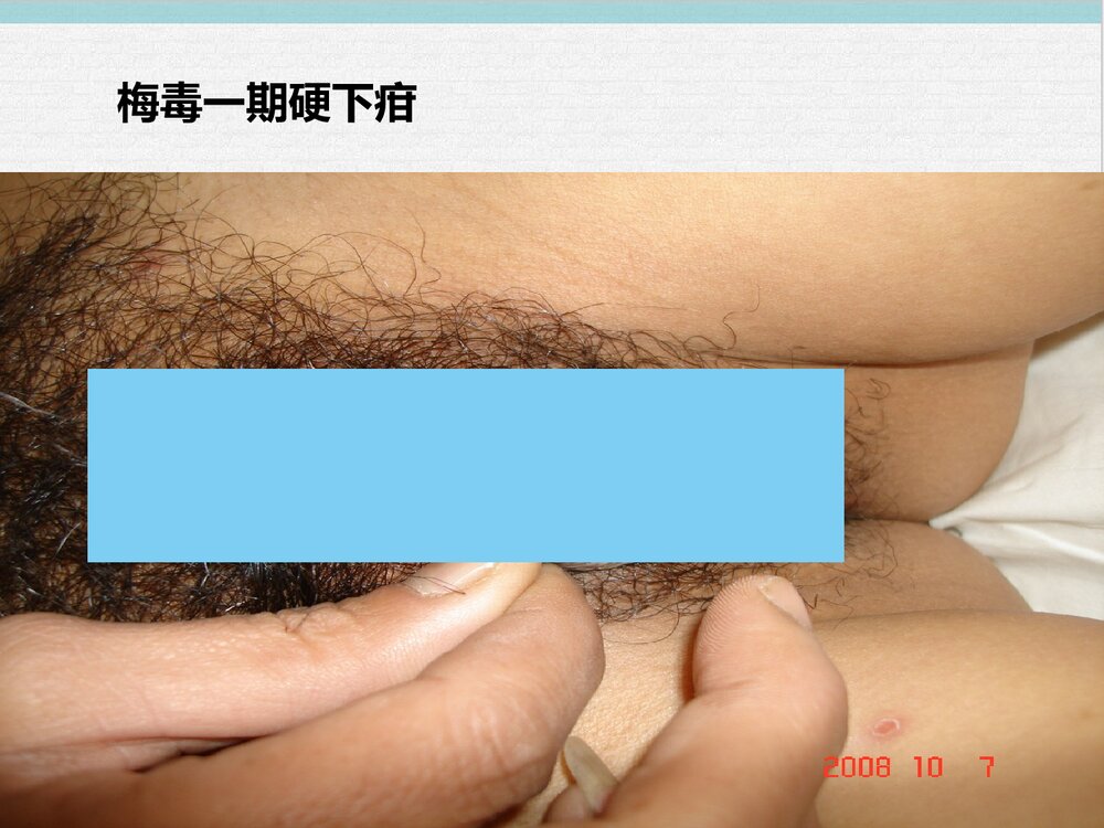 梅毒护理查房PPT课件下载(共20页)6