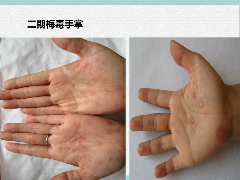 梅毒护理查房PPT课件下载(共20页)9