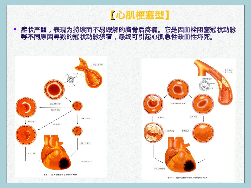 心血管疾病健康讲座PPT课件下载7