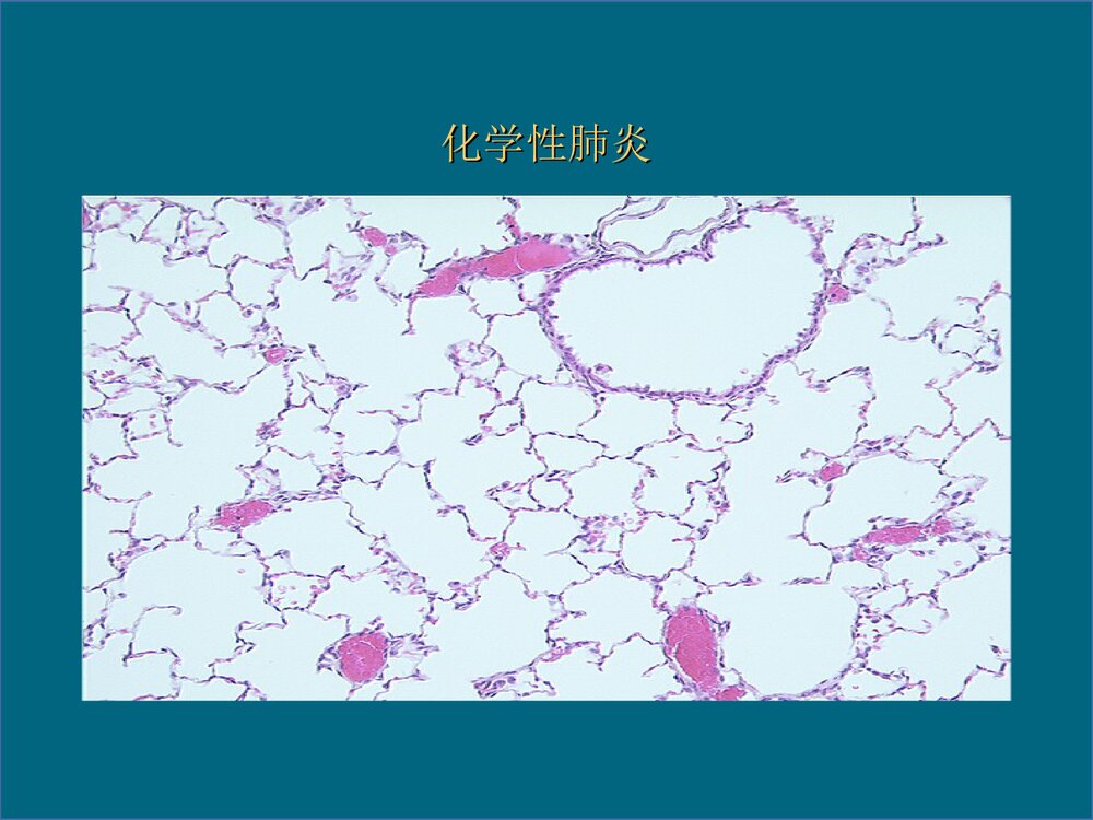 生产性粉尘与职业性肺部疾患PPT课件下载9