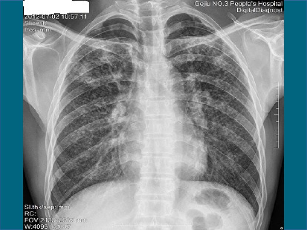 生产性粉尘与职业性肺部疾患PPT课件下载10