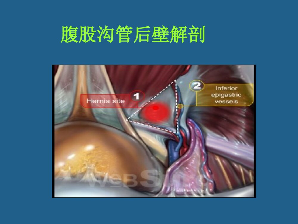 腹腔镜疝修补术TAPP与TEP课件PPT下载5