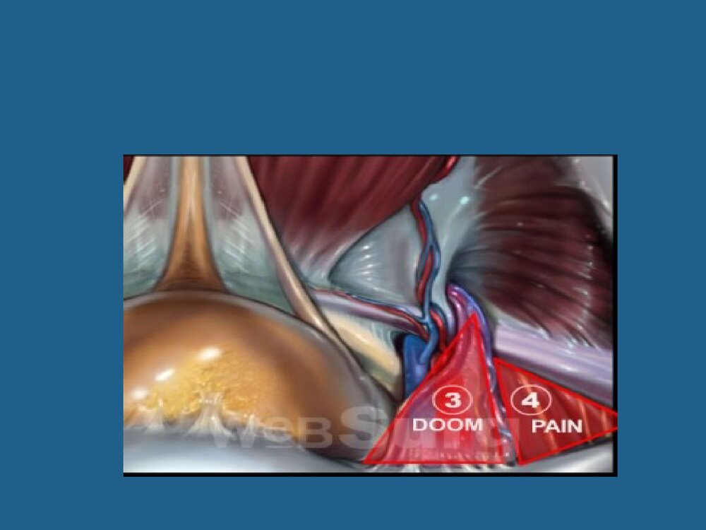 腹腔镜疝修补术TAPP与TEP课件PPT下载6