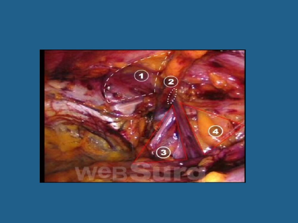 腹腔镜疝修补术TAPP与TEP课件PPT下载7