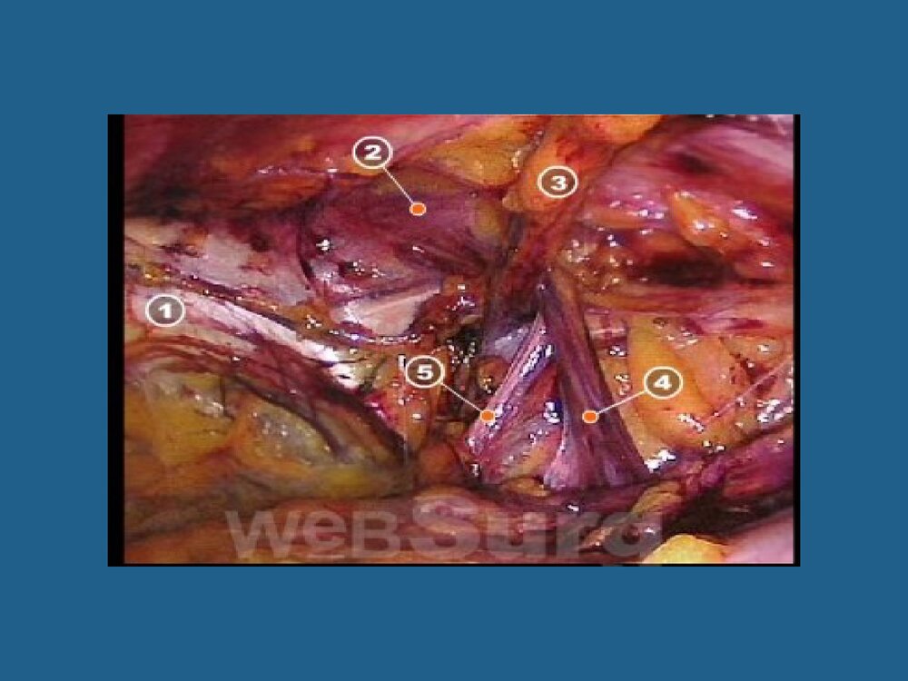 腹腔镜疝修补术TAPP与TEP课件PPT下载8