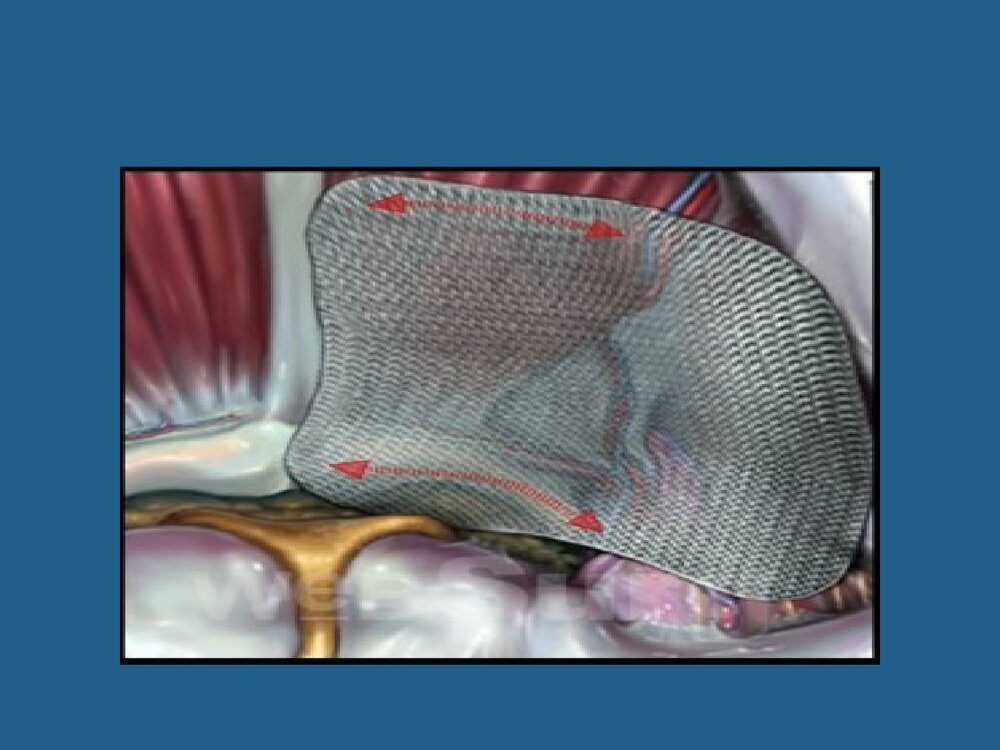 腹腔镜疝修补术TAPP与TEP课件PPT下载9