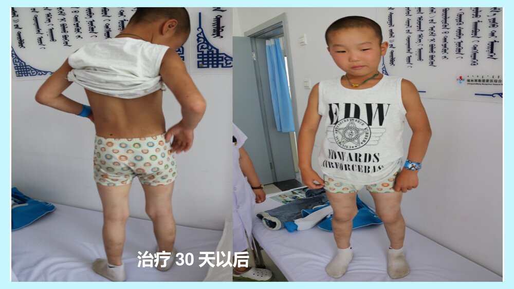 蒙医牛角拔罐及护理PPT课件下载(共24页)10