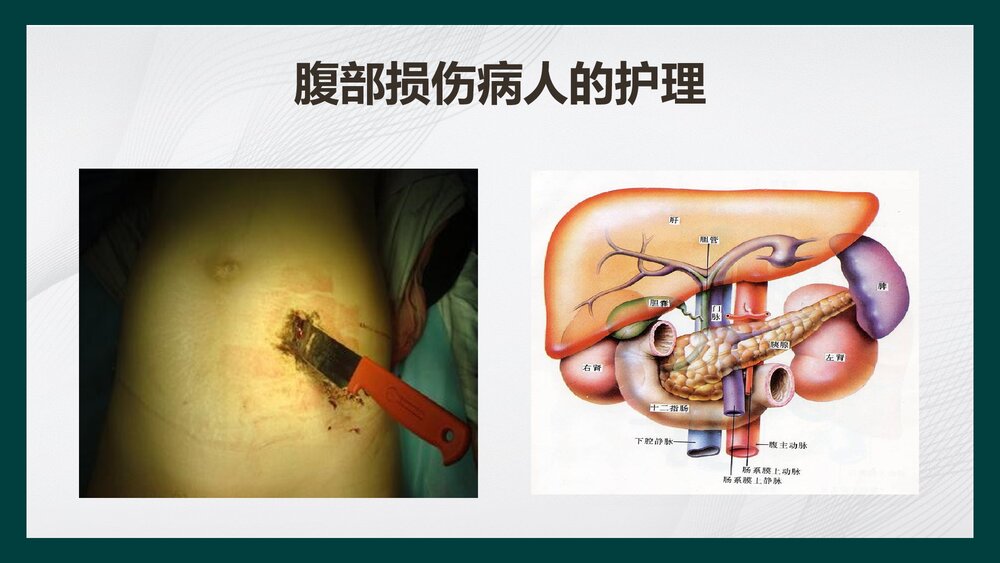 腹部损伤病人的护理PPT课件下载1