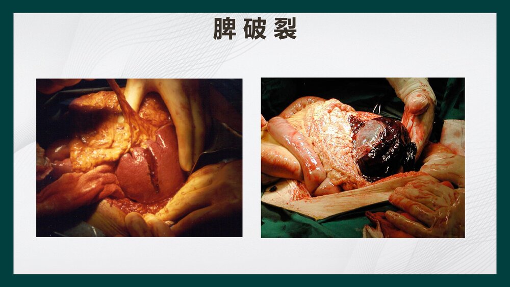 腹部损伤病人的护理PPT课件下载8