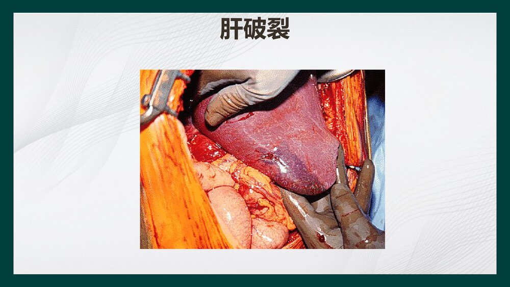 腹部损伤病人的护理PPT课件下载10