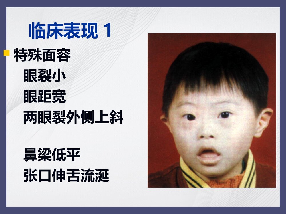 21三体综合征PPT课件下载(共28页·内容可修改编辑)9