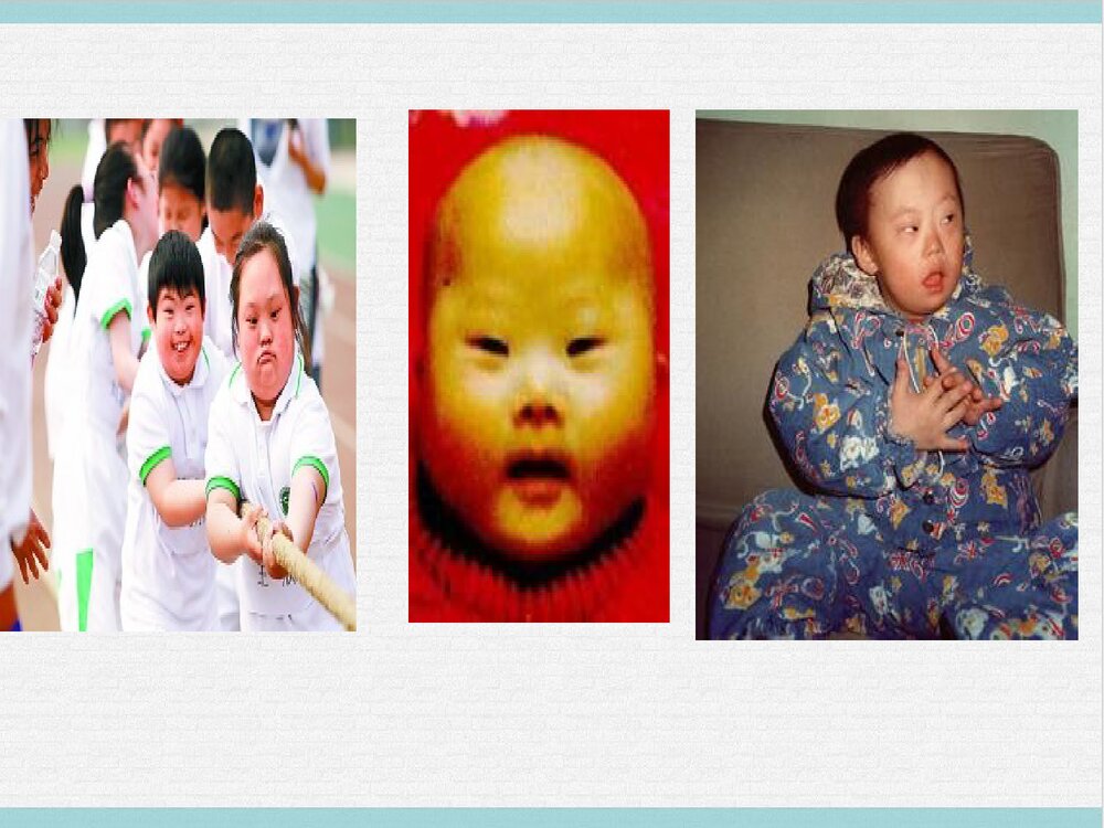 21三体综合征PPT课件下载5