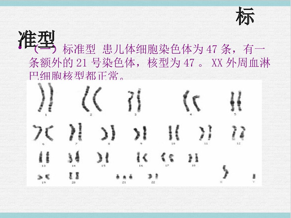 21三体综合征PPT课件下载8