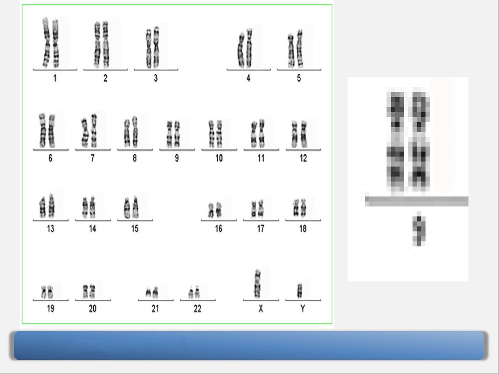 9号染色体三体嵌合型综合症PPT课件下载4