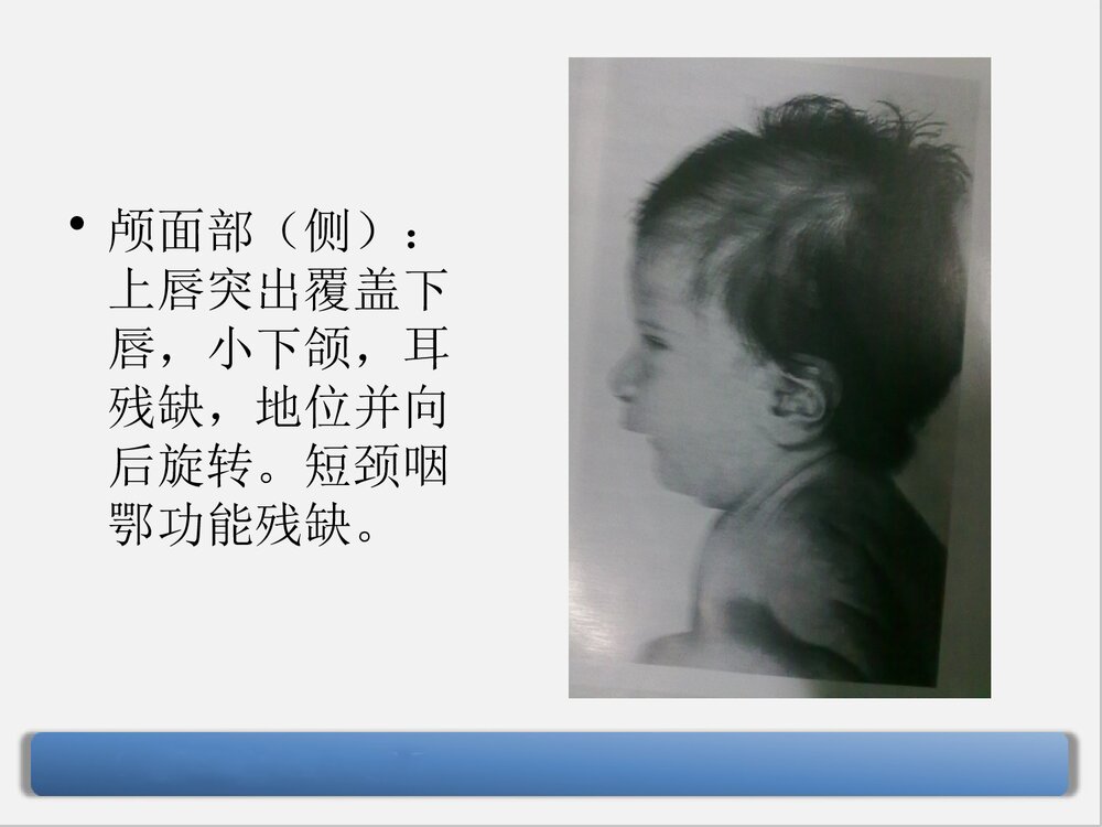 9号染色体三体嵌合型综合症PPT课件下载8