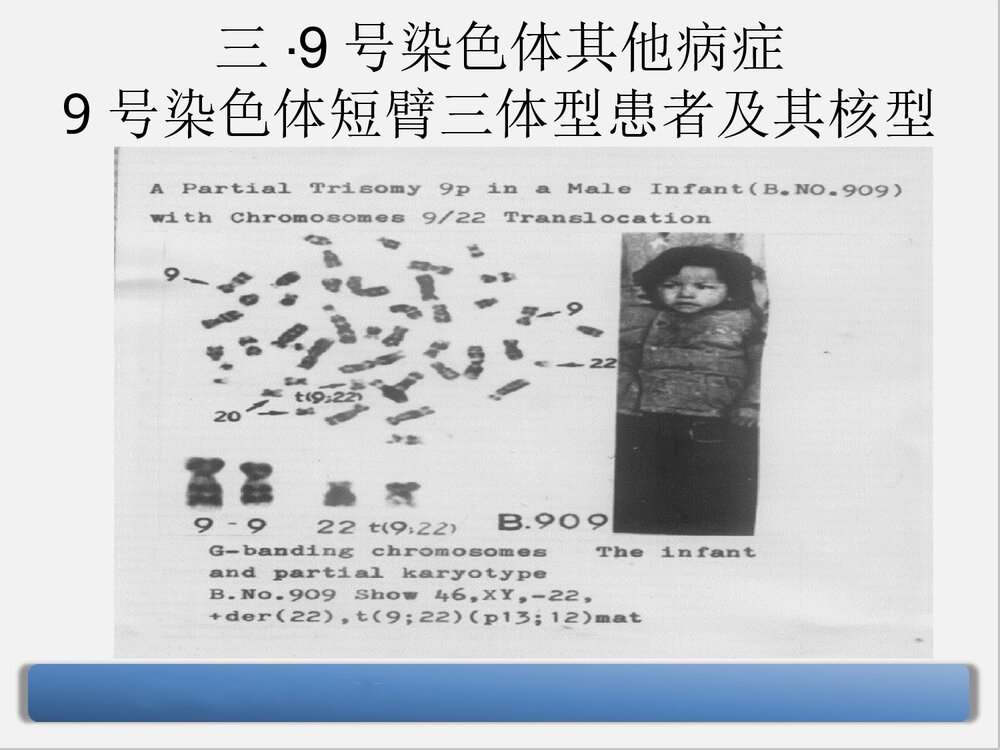 9号染色体三体嵌合型综合症PPT课件下载9