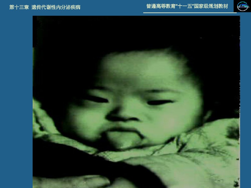 儿科学 第十三章 遗传代谢性内分泌疾病·21 三体综合征PPT课件下载6