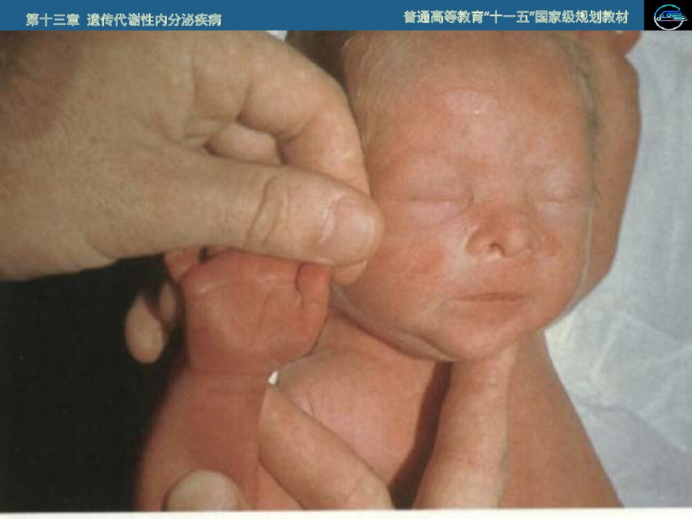 儿科学 第十三章 遗传代谢性内分泌疾病·21 三体综合征PPT课件下载9
