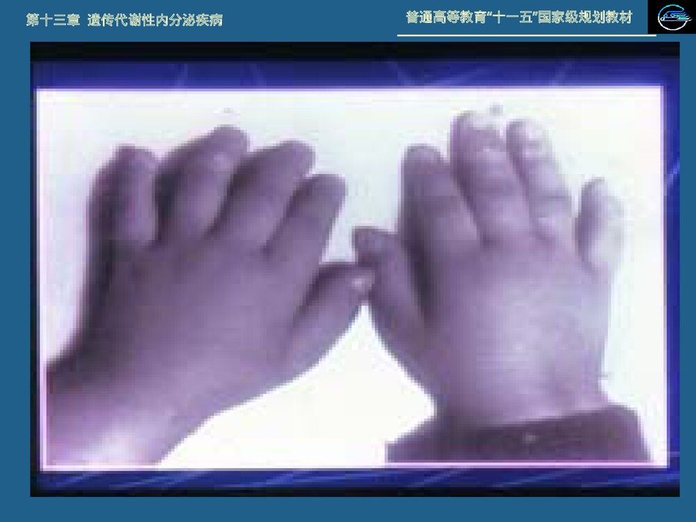 儿科学 第十三章 遗传代谢性内分泌疾病·21 三体综合征PPT课件下载10
