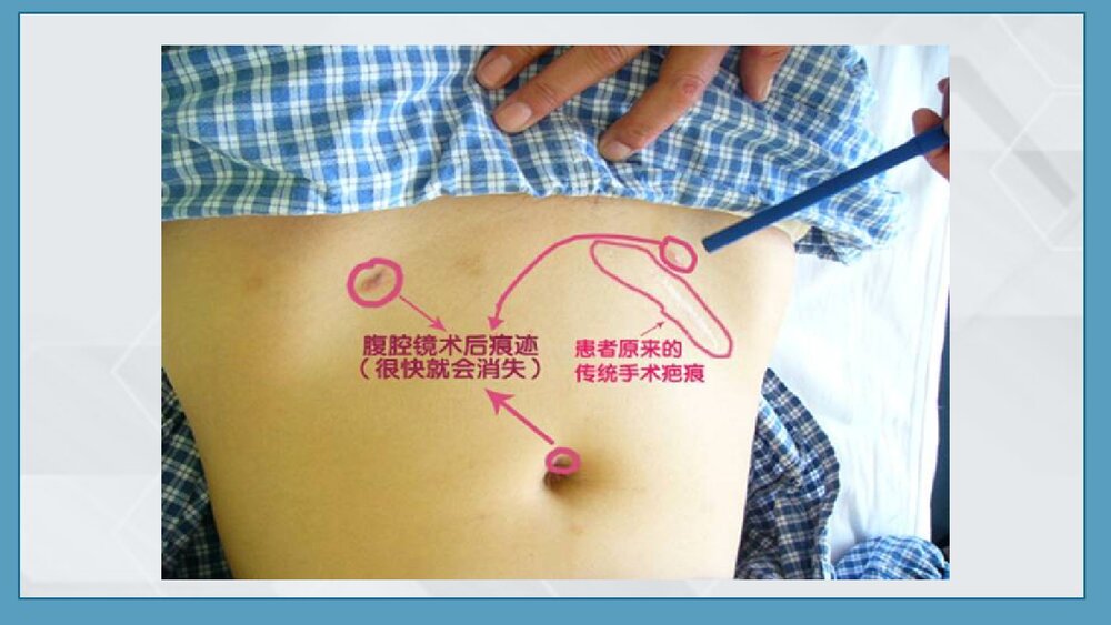 腹腔镜手术前后的护理PPT课件下载(共23页)3