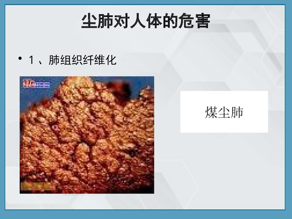尘肺的病因、发病原理及防治PPT课件下载9