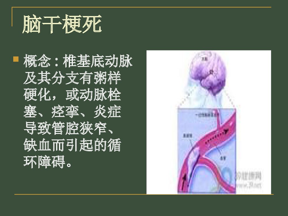 脑干梗死护理查房PPT课件下载4