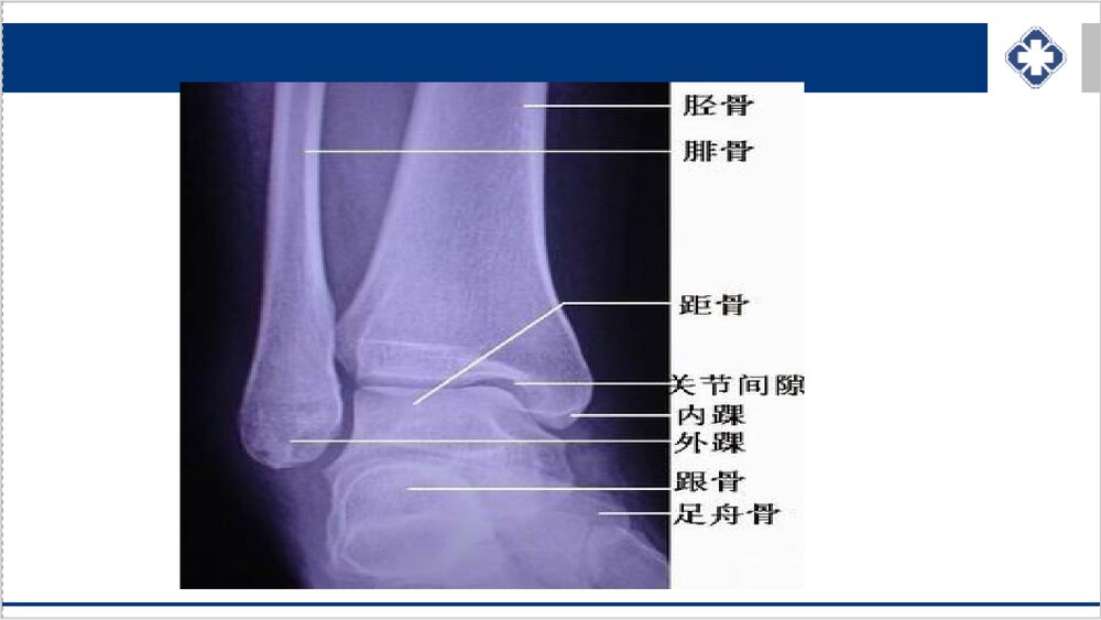 踝关节骨折的护理PPT课件下载5