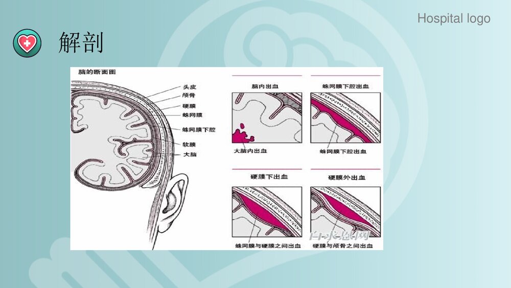 蛛网膜下腔出血PPT课件3