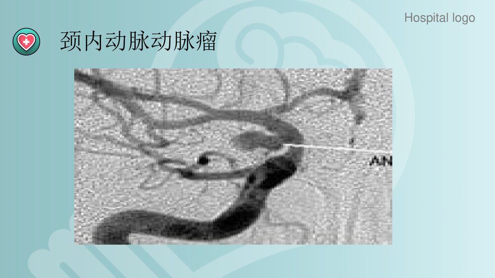 蛛网膜下腔出血PPT课件7