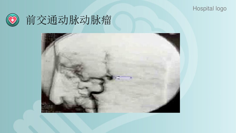 蛛网膜下腔出血PPT课件8