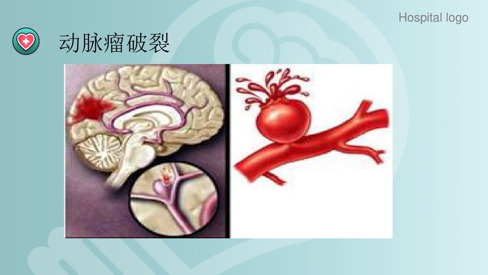 蛛网膜下腔出血PPT课件9